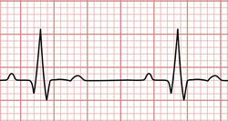 Normal electrocardiogram - sinus rhythm