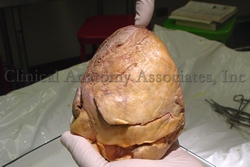 Human heart - Cardiac apex