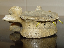 Spondylophytes on a lumbar vertebra
