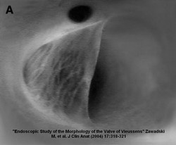 Valve of Vieussens. The opening of the great cardiac vein is partially closed by the valve. The ostium of the oblique vein can be seen above the valve