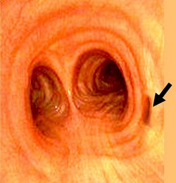 Tracheal bronchus (pig bronchus)