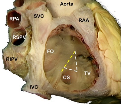 Triangle of Koch, location of the AV node