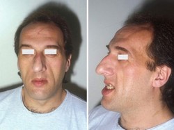 A patient with acromegaly and prognathism
