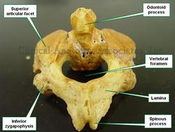 C2 - Axis. Posterosuperior view.