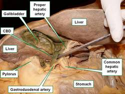 Anteroinferior view of the liver and stomach. CBD= Common bile duct