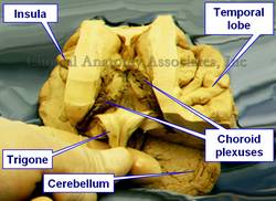 Human brain dissection - open lateral ventricles