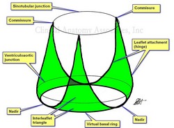 Interleaflet triangles of the aortic valve by MTD