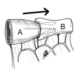 Intussusception