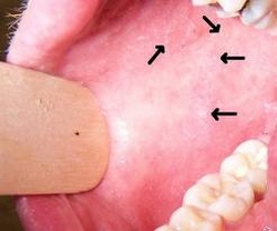 Koplik's spots on the buccal mucosa