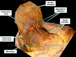 Dissection of the abdomen. The greater omentum is being pulled anteriorly