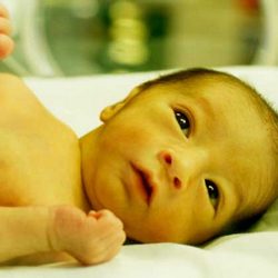 Newborn with kernicterus jaundice