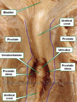 Anterior view of section of the prostate. The blue dotted line shows the edges of the prostatic urethra