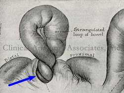 Volvulus - Thorek (1938) Volvulus - Thorek (1938)